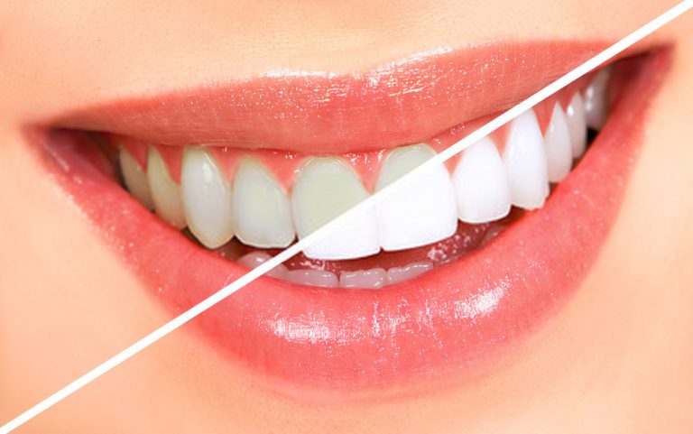 Different Types of Cosmetic Dental Procedure