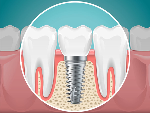 dental_implants