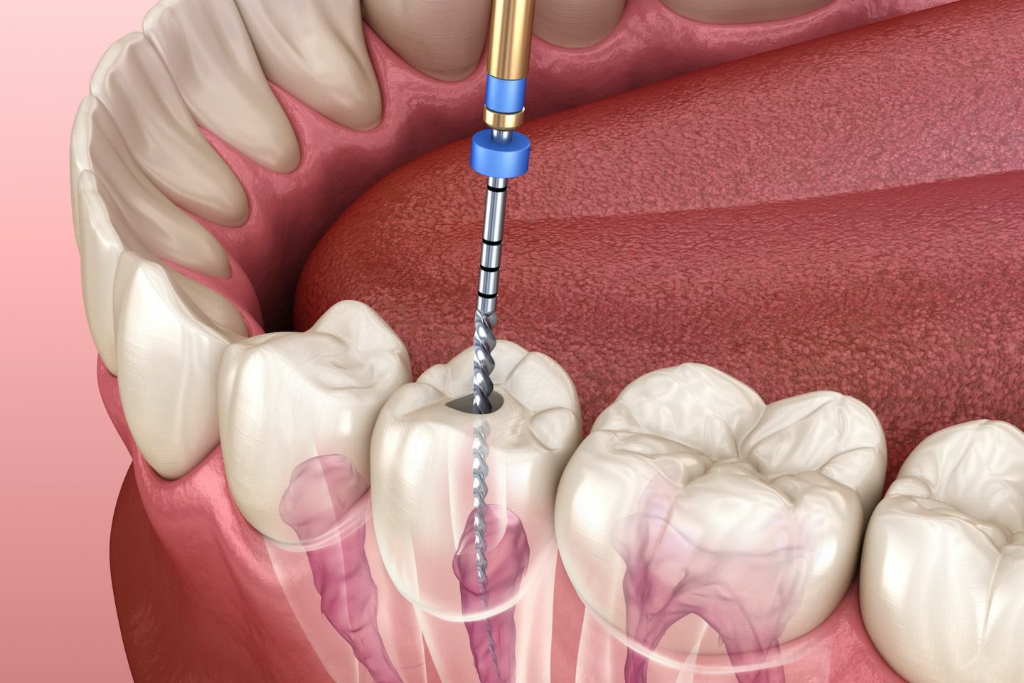 Avail Best Root Canal Treatment with Ideal Smile Dentistry