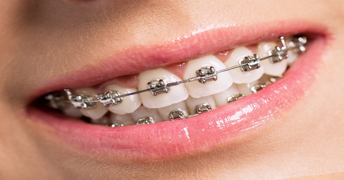 What are the Benefits of Wearing Braces?