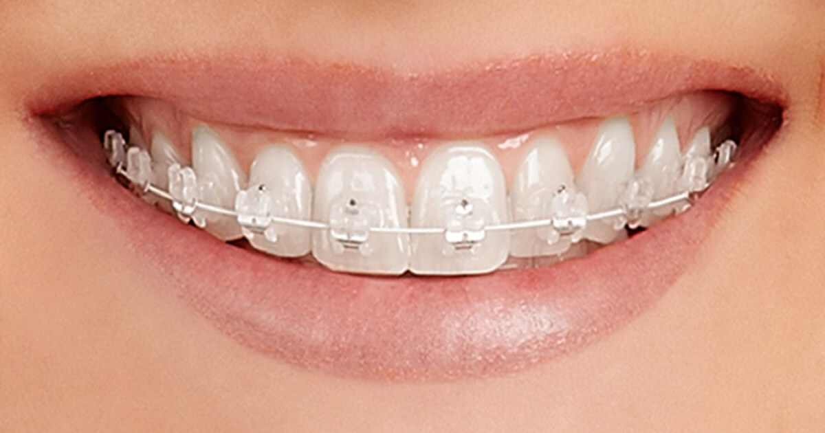 Things You Need to Know About Fixed Braces